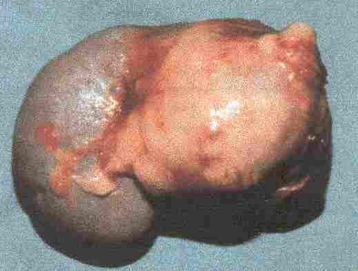 Redevet tumor0adrenal