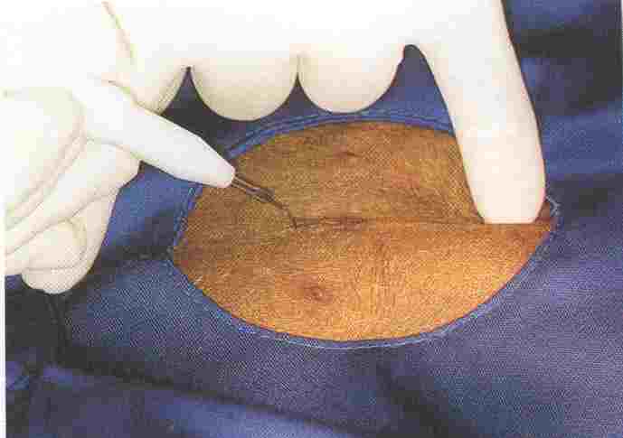 Redevet ovariosalpingo