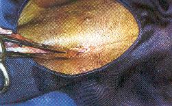 Redevet ovariosalpingo6