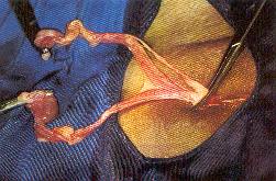 Redevet ovariosalpingo7