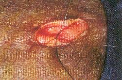 Redevet ovariosalpingo8